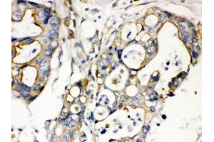 Anti- Plectin Picoband antibody, IHC(P) IHC(P): Human Intestinal Cancer Tissue (PLEC Antikörper  (Middle Region))