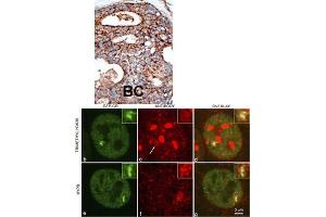 Formalin-fixed and paraffin-embedded human cancer tissue reacted with the primary antibody, which was peroxidase-conjugated to the secondary antibody, followed by DAB staining. (SETD2 Antikörper  (N-Term))