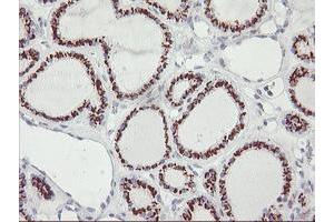 Immunohistochemical staining of paraffin-embedded Carcinoma of Human thyroid tissue using anti-GOLM1 mouse monoclonal antibody. (GOLM1 Antikörper)