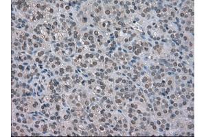 Immunohistochemical staining of paraffin-embedded Carcinoma of kidney tissue using anti-NAT8mouse monoclonal antibody. (NAT8 Antikörper)