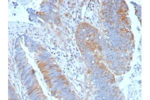 Formalin-fixed, paraffin-embedded human Colon Carcinoma stained with Calpain 1 Mouse Monoclonal Antibody (CAPN1/1530). (CAPNL1 Antikörper)