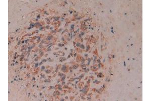 IHC-P analysis of Human Lung cancer Tissue, with DAB staining. (CD8B Antikörper  (AA 22-170))