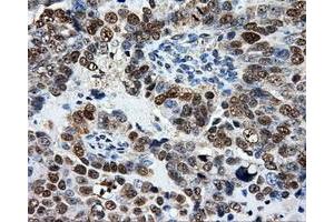 Immunohistochemical staining of paraffin-embedded Adenocarcinoma of breast tissue using anti-ATP5B mouse monoclonal antibody. (ATP5B Antikörper)