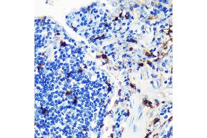 Immunohistochemistry of paraffin-embedded human lung cancer using S100 Rabbit mAb (ABIN7270128) at dilution of 1:100 (40x lens). (S100A8 Antikörper)