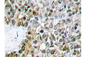 Immunohistochemistry analyzes of Caspase 9 antibody in paraffin-embedded human lung carcinoma tissue. (Caspase 9 Antikörper)