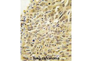 Formalin-fixed and paraffin-embedded human lung carcinoma tissue reacted with UBQLN2 polyclonal antibody  , which was peroxidase-conjugated to the secondary antibody, followed by DAB staining. (Ubiquilin 2 Antikörper  (N-Term))