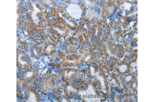 Immunohistochemistry of Human thyroid cancer using AGL Polyclonal Antibody at dilution of 1:30 (AGL Antikörper)