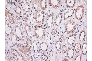 Immunohistochemical staining of paraffin-embedded Carcinoma of lung using anti-Stat4 (ABIN2452527) mouse monoclonal antibody. (STAT4 Antikörper  (AA 633-652))
