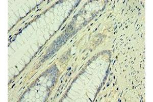 Immunohistochemistry of paraffin-embedded human colon cancer using ABIN7171560 at dilution of 1:100 (TAF1B Antikörper  (AA 369-588))