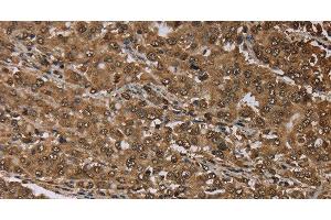 Immunohistochemistry of paraffin-embedded Human liver cancer tissue using MEIS1 Polyclonal Antibody at dilution 1:30 (MEIS1 Antikörper)