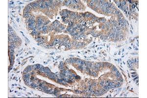 Immunohistochemical staining of paraffin-embedded Adenocarcinoma of Human colon tissue using anti-IGF2BP2 mouse monoclonal antibody. (IGF2BP2 Antikörper)