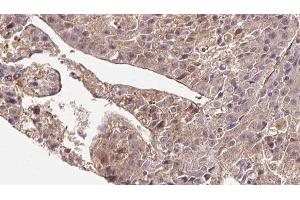ABIN6279838 at 1/100 staining Human liver cancer tissue by IHC-P. (SLC4A7 Antikörper  (Internal Region))