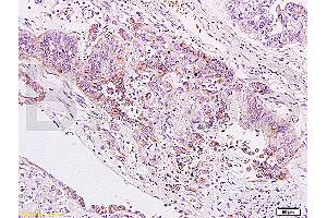 Formalin-fixed and paraffin embedded human gastric carcinoma labeled Anti-B7H4 Polyclonal Antibody, Unconjugated (ABIN671736) at 1:200, followed by conjugation to the secondary antibody and DAB staining (VTCN1 Antikörper  (AA 50-100))
