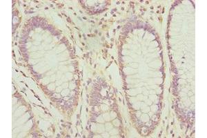 Immunohistochemistry of paraffin-embedded human colon cancer using ABIN7164691 at dilution of 1:100 (PDCD2L Antikörper  (AA 1-358))