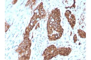 Formalin-fixed, paraffin-embedded human Breast Carcinoma stained with PDZ and LIM Domain 1 Mouse Monoclonal Antibody (PDLIM-1). (PDLIM1 Antikörper)