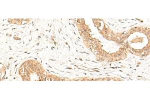 Immunohistochemistry of paraffin-embedded Human breast cancer tissue using FBXL4 Polyclonal Antibody at dilution of 1:25(x200)