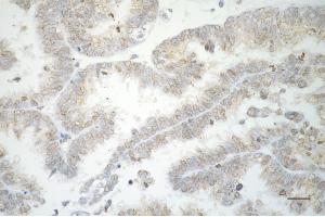 Immunohistochemistry was performed on paraffin-embedded human ovarian carcinoma using RAD51 recombinase antibody (ABIN7798367), 1:200). (Rekombinanter RAD51 Antikörper)