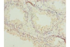 Immunohistochemistry of paraffin-embedded human prostate cancer using ABIN7143059 at dilution of 1:100 (Actl7b Antikörper  (AA 1-415))