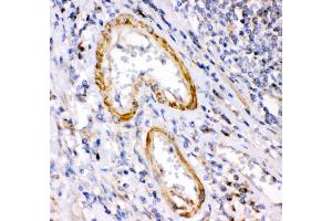 Anti- Calretinin Picoband antibody, IHC(P) IHC(P): Human Intestinal Cancer Tissue (Calretinin Antikörper  (C-Term))
