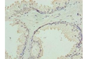 Immunohistochemistry of paraffin-embedded human prostate cancer using ABIN7154735 at dilution of 1:100