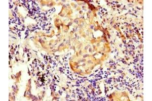 Immunohistochemistry of paraffin-embedded human lung cancer using ABIN7161015 at dilution of 1:100 (NOXA1 Antikörper  (AA 150-313))