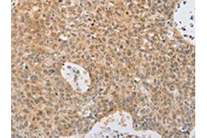 The image on the left is immunohistochemistry of paraffin-embedded Human lung cancer tissue using ABIN7131039(SERPINE2 Antibody) at dilution 1/20, on the right is treated with fusion protein. (SERPINE2 Antikörper)
