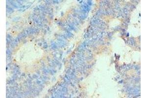 Immunohistochemistry of paraffin-embedded human colon cancer using ABIN7155937 at dilution of 1:100 (HIP1 Antikörper  (AA 410-690))