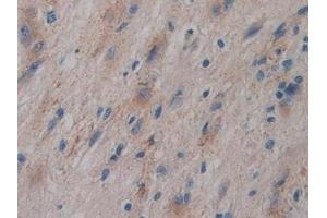 Detection of GPLD1 in Human Glioma Tissue using Polyclonal Antibody to Glycosylphosphatidylinositol Specific Phospholipase D1 (GPLD1)