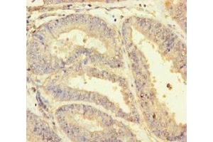 Immunohistochemistry of paraffin-embedded human endometrial cancer using ABIN7154855 at dilution of 1:100 (HSPA12B Antikörper  (AA 201-500))