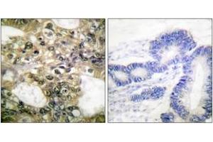 Immunohistochemistry analysis of paraffin-embedded human colon carcinoma tissue, using HDAC6 Antibody. (HDAC6 Antikörper  (AA 1166-1215))
