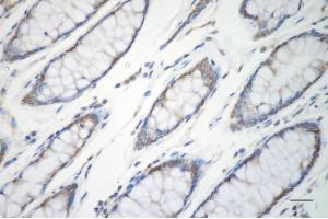 Immunohistochemistry was performed on paraffin-embedded human sigmoid colon carcinoma using ERK1 antibody (ABIN7799449), 1:200). (Rekombinanter ERK1 Antikörper)