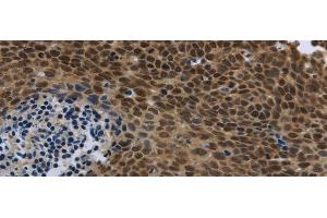 Immunohistochemistry of paraffin-embedded Human cervical cancer using SMAD4 Polyclonal Antibody at dilution of 1/40 (SMAD4 Antikörper)