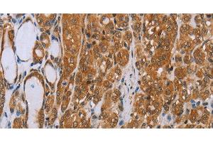 Immunohistochemistry of paraffin-embedded Human thyroid cancer tissue using ADAMTS15 Polyclonal Antibody at dilution 1:40 (ADAMTS15 Antikörper)
