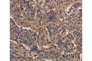 Immunohistochemistry of Human prostate cancer using MAP1LC3C Polyclonal Antibody at dilution of 1:40 (LC3C Antikörper)