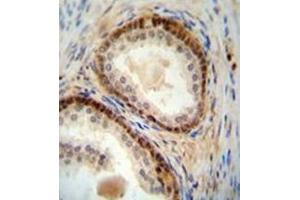 Immunohistochemistry analysis in formalin fixed and paraffin embedded human prostate carcinoma reacted with NUDT8 Antibody (N-term) followed by peroxidase conjugation of the secondary antibody and DAB staining.
