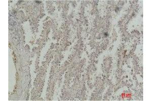 Immunohistochemistry (IHC) analysis of paraffin-embedded Human Lung Carcinoma using CREB-1 Monoclonal Antibody. (CREB1 Antikörper)