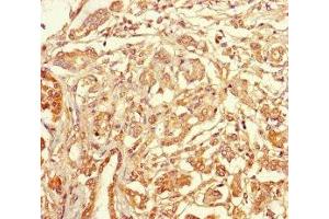 Immunohistochemistry of paraffin-embedded human pancreatic cancer using ABIN7171887 at dilution of 1:100 (Tetraspanin 7 Antikörper  (AA 113-223))
