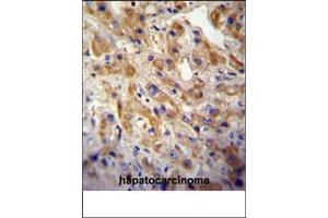 MET/HGFR Antibody (ABIN387742 and ABIN2838000) immunohistochemistry analysis in formalin fixed and paraffin embedded human hepatocarcinoma followed by peroxidase conjμgation of the secondary antibody and DAB staining. (c-MET Antikörper  (Catalytic Domain))