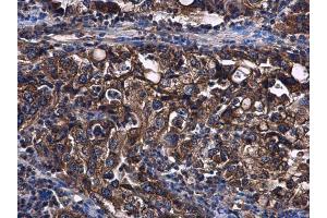 IHC-P Image STAT2 antibody [C2C3], C-term detects STAT2 protein at cytoplasm in human endometrial carcinoma by immunohistochemical analysis. (STAT2 Antikörper  (C-Term))