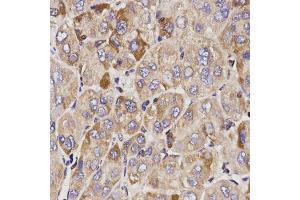 Immunohistochemistry of paraffin-embedded human liver cancer using GAS2 antibody. (GAS2 Antikörper)