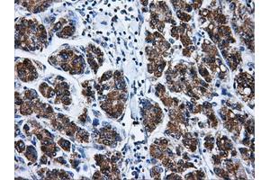 Immunohistochemical staining of paraffin-embedded Carcinoma of liver tissue using anti-BIRC7mouse monoclonal antibody. (BIRC7 Antikörper)