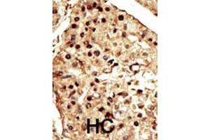 Formalin-fixed and paraffin-embedded human cancer tissue reacted with the primary antibody, which was peroxidase-conjugated to the secondary antibody, followed by DAB staining. (TRPM7 Antikörper  (C-Term))