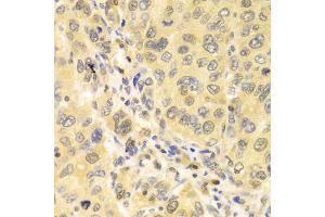 Immunohistochemistry of paraffin-embedded human liver cancer using IRF3 antibody (ABIN4904080) at dilution of 1:100 (40x lens). (IRF3 Antikörper)