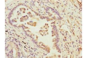 Immunohistochemistry of paraffin-embedded human lung cancer using ABIN7145189 at dilution of 1:100 (B9D2 Antikörper  (AA 1-175))