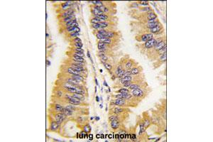 Formalin-fixed and paraffin-embedded human lung carcinoma tissue reacted with FRAT1 polyclonal antibody  , which was peroxidase-conjugated to the secondary antibody, followed by DAB staining. (FRAT1 Antikörper  (C-Term))