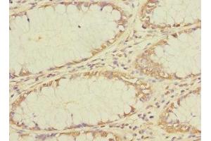 Immunohistochemistry of paraffin-embedded human colon cancer using ABIN7173139 at dilution of 1:100 (FAM156A Antikörper  (AA 251-519))