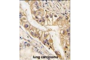 Formalin-fixed and paraffin-embedded human lung carcinoma tissue reacted with EPHB2 Monoclonal Antibody (ABIN387812 and ABIN2843903) , which was peroxidase-conjugated to the secondary antibody, followed by DAB staining. (EPH Receptor B2 Antikörper)