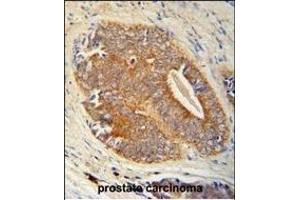 GAGE7 Antibody (C-term) (ABIN653712 and ABIN2843026) immunohistochemistry analysis in formalin fixed and paraffin embedded human prostate carcinoma followed by peroxidase conjugation of the secondary antibody and DAB staining. (G Antigen 7 Antikörper  (C-Term))