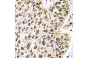 Immunohistochemistry of paraffin-embedded human lung cancer using 42254 antibody at dilution of 1:100 (x40 lens). (Septin 7 Antikörper)