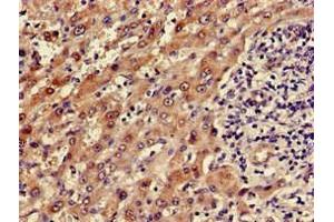 Immunohistochemistry of paraffin-embedded human liver cancer using ABIN7143656 at dilution of 1:100 (ADH5 Antikörper  (AA 14-130))